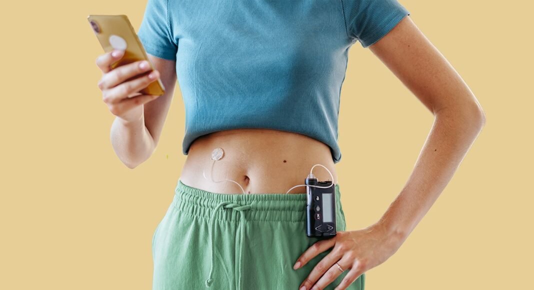 Should You Be Using Automated Insulin Delivery (AID) for Type 1 Diabetes?